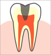 歯髄に達する虫歯(C3)