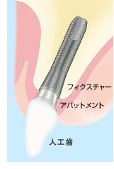 インプラント治療